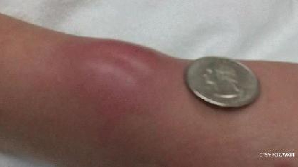 Hair Tie Health Risk After Woman S Infection Wham